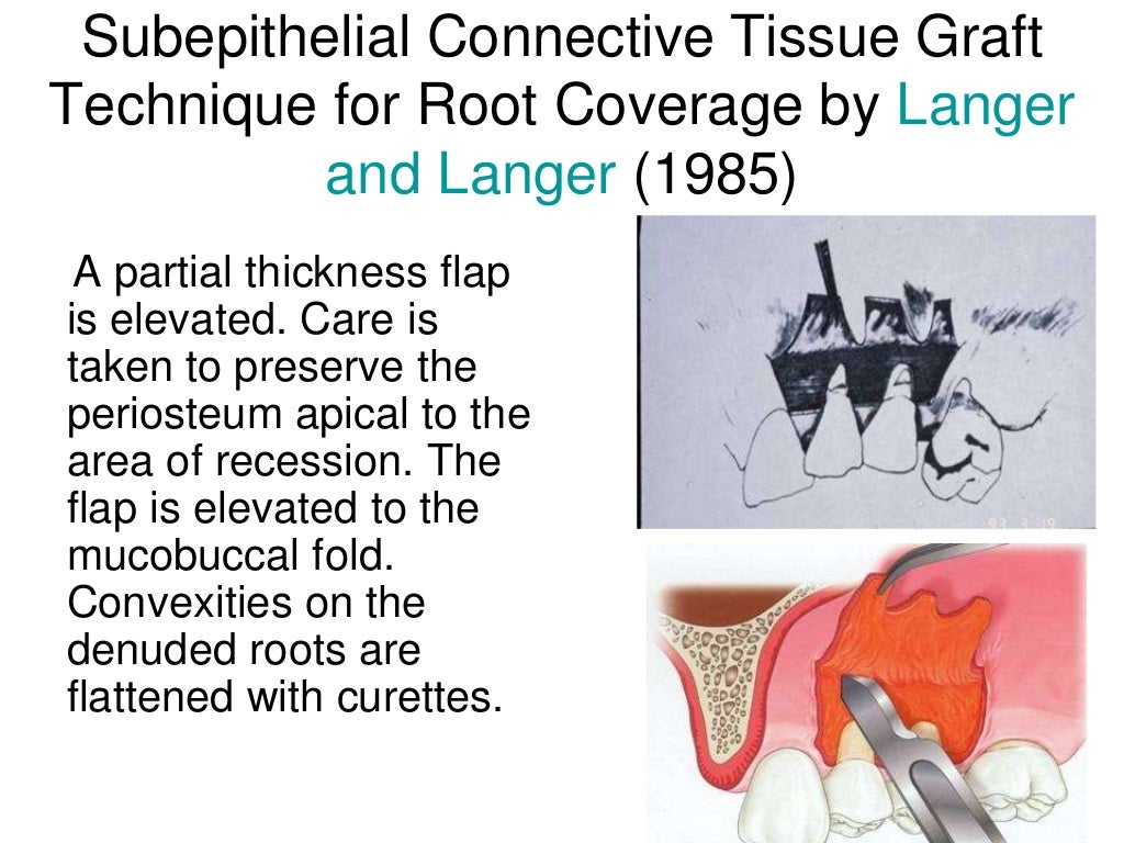 An Alternative to Autogenous Connective Tissue Grafting for Root Cove…
