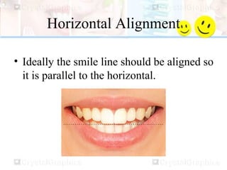 Horizontal Alignment
• Ideally the smile line should be aligned so
it is parallel to the horizontal.
 