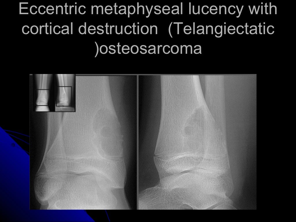 Analysis of focal lucent bony lesion