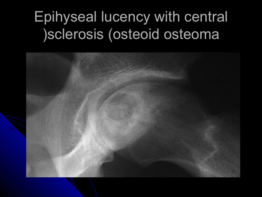 Analysis of focal lucent bony lesion