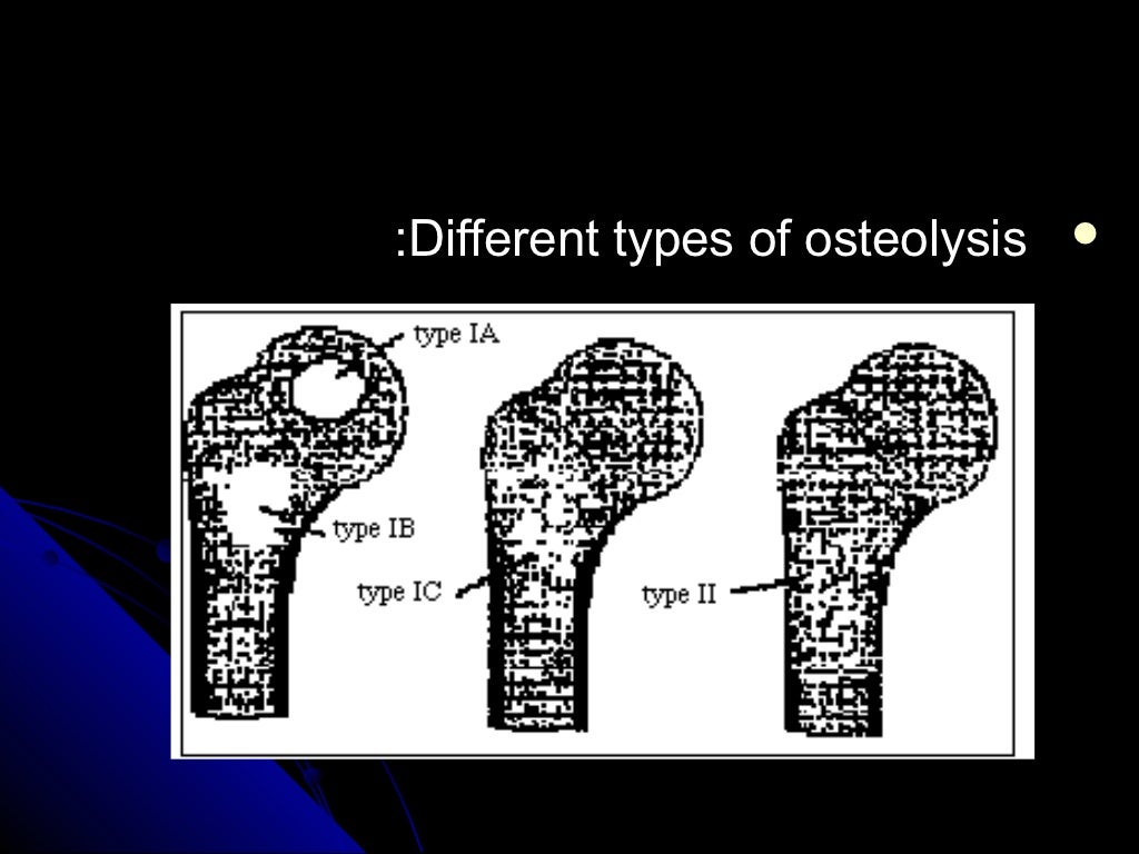Analysis of focal lucent bony lesion