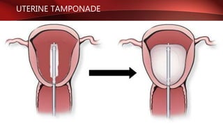 UTERINE TAMPONADE
 
