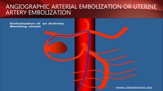ANGIOGRAPHIC ARTERIAL EMBOLIZATION OR UTERINE
ARTERY EMBOLIZATION
 