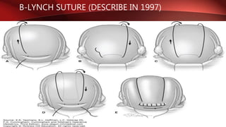 B-LYNCH SUTURE (DESCRIBE IN 1997)
 
