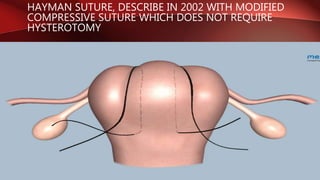 HAYMAN SUTURE, DESCRIBE IN 2002 WITH MODIFIED
COMPRESSIVE SUTURE WHICH DOES NOT REQUIRE
HYSTEROTOMY
 