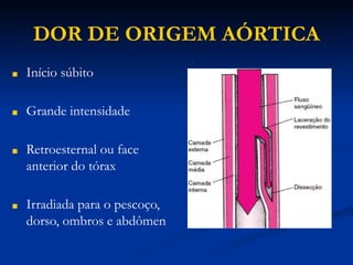 DOR DE ORIGEM AÓRTICA
■ Início súbito
■ Grande intensidade
■ Retroesternal ou face
anterior do tórax
■ Irradiada para o pescoço,
dorso, ombros e abdômen
 