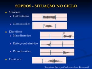 SOPROS - SITUAÇÃO NO CICLO
■ Sistólicos
■ Holossitólico
■ Mesossistólico
■ Diastólicos
■ Mesodiastólico
■ Reforço pré-sistólico
■ Protodiastólico
■ Contínuos
Tratado de Doenças Cardiovasculares, Braunwald
 