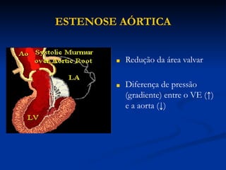 ESTENOSE AÓRTICA
■ Redução da área valvar
■ Diferença de pressão
(gradiente) entre o VE (↑)
e a aorta (↓)
 