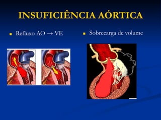 INSUFICIÊNCIA AÓRTICA
■ Refluxo AO → VE ■ Sobrecarga de volume
 