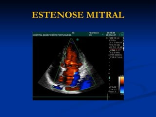 ESTENOSE MITRAL
 