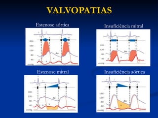 VALVOPATIAS
Estenose aórtica
Estenose mitral
Insuficiência mitral
Insuficiência aórtica
 