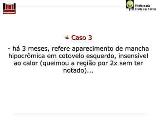Caso 3
- há 3 meses, refere aparecimento de mancha
hipocrômica em cotovelo esquerdo, insensível
ao calor (queimou a região por 2x sem ter
notado)...

 