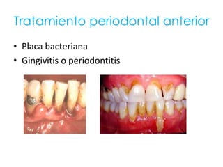 Tratamiento periodontal anterior
• Placa bacteriana
• Gingivitis o periodontitis
 