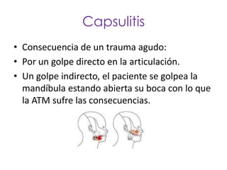 Capsulitis
• Consecuencia de un trauma agudo:
• Por un golpe directo en la articulación.
• Un golpe indirecto, el paciente se golpea la
  mandíbula estando abierta su boca con lo que
  la ATM sufre las consecuencias.
 