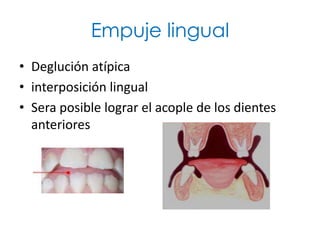 Empuje lingual
• Deglución atípica
• interposición lingual
• Sera posible lograr el acople de los dientes
  anteriores
 