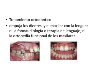 • Tratamiento ortodontico
• empuja los dientes y el maxilar con la lengua:
  ni la fonoaudiología o terapia de lenguaje, ni
  la ortopedia funcional de los maxilares.
 