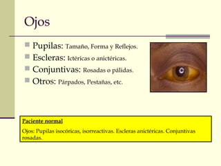 Ojos 
 Pupilas: Tamaño, Forma y Reflejos. 
 Escleras: Ictéricas o anictéricas. 
 Conjuntivas: Rosadas o pálidas. 
 Otros: Párpados, Pestañas, etc. 
Paciente normal 
Ojos: Pupilas isocóricas, isorreactivas. Escleras anictéricas. Conjuntivas 
rosadas. 
 