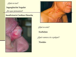 ¿Qué es eso? 
Ingurgitación Yugular 
¿En que pensamos? 
Insuficiencia Cardiaca Derecha 
¿Qué es esto? 
Exoftalmo 
¿Qué vamos a ir a palpar? 
Tiroides 
 
