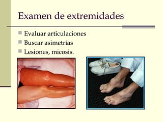 Examen de extremidades 
 Evaluar articulaciones 
 Buscar asimetrías 
 Lesiones, micosis. 
 