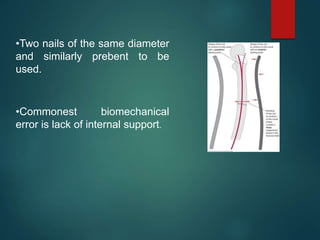•Two nails of the same diameter
and similarly prebent to be
used.
•Commonest biomechanical
error is lack of internal support.
 