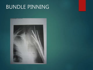 BUNDLE PINNING
 