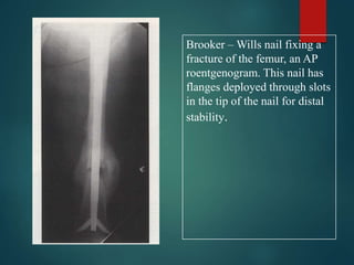 Brooker – Wills nail fixing a
fracture of the femur, an AP
roentgenogram. This nail has
flanges deployed through slots
in the tip of the nail for distal
stability.
 