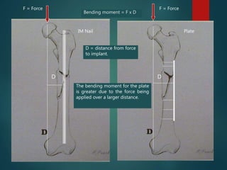 Bending moment = F x D
F = Force
D
F = Force
D
The bending moment for the plate
is greater due to the force being
applied over a larger distance.
IM Nail Plate
D = distance from force
to implant.
 