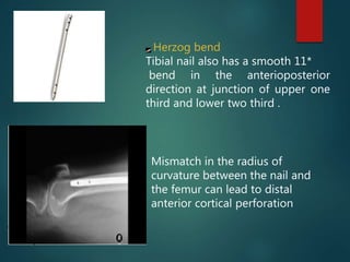 Herzog bend
Tibial nail also has a smooth 11*
bend in the anterioposterior
direction at junction of upper one
third and lower two third .
Mismatch in the radius of
curvature between the nail and
the femur can lead to distal
anterior cortical perforation
 