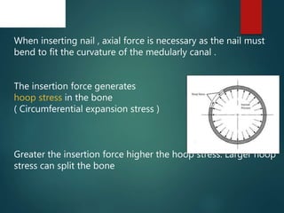 When inserting nail , axial force is necessary as the nail must
bend to fit the curvature of the medularly canal .
The insertion force generates
hoop stress in the bone
( Circumferential expansion stress )
Greater the insertion force higher the hoop stress. Larger hoop
stress can split the bone
 