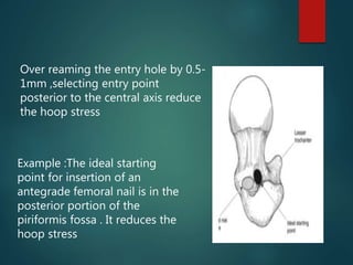 Over reaming the entry hole by 0.5-
1mm ,selecting entry point
posterior to the central axis reduce
the hoop stress
Example :The ideal starting
point for insertion of an
antegrade femoral nail is in the
posterior portion of the
piriformis fossa . It reduces the
hoop stress
 