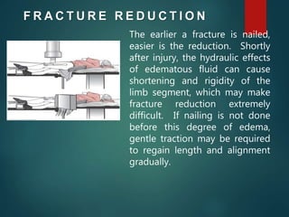 F R A C T U R E R E D U C T I O N
The earlier a fracture is nailed,
easier is the reduction. Shortly
after injury, the hydraulic effects
of edematous fluid can cause
shortening and rigidity of the
limb segment, which may make
fracture reduction extremely
difficult. If nailing is not done
before this degree of edema,
gentle traction may be required
to regain length and alignment
gradually.
 