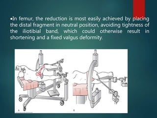 In femur, the reduction is most easily achieved by placing
the distal fragment in neutral position, avoiding tightness of
the iliotibial band, which could otherwise result in
shortening and a fixed valgus deformity.
 