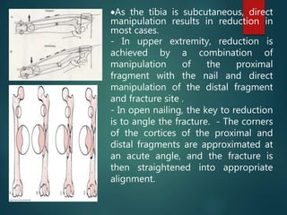 As the tibia is subcutaneous, direct
manipulation results in reduction in
most cases.
- In upper extremity, reduction is
achieved by a combination of
manipulation of the proximal
fragment with the nail and direct
manipulation of the distal fragment
and fracture site .
- In open nailing, the key to reduction
is to angle the fracture. - The corners
of the cortices of the proximal and
distal fragments are approximated at
an acute angle, and the fracture is
then straightened into appropriate
alignment.
 