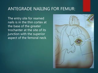 The entry site for reamed
nails is in the thin cortex at
the base of the greater
trochanter at the site of its
junction with the superior
aspect of the femoral neck.
ANTEGRADE NAILING FOR FEMUR:
 