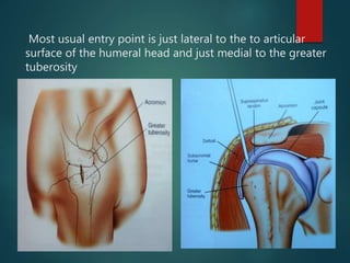 Most usual entry point is just lateral to the to articular
surface of the humeral head and just medial to the greater
tuberosity
 