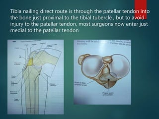 Tibia nailing direct route is through the patellar tendon into
the bone just proximal to the tibial tubercle , but to avoid
injury to the patellar tendon, most surgeons now enter just
medial to the patellar tendon
 