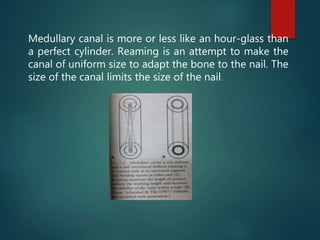Medullary canal is more or less like an hour-glass than
a perfect cylinder. Reaming is an attempt to make the
canal of uniform size to adapt the bone to the nail. The
size of the canal limits the size of the nail.
 