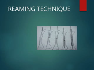 REAMING TECHNIQUE
 