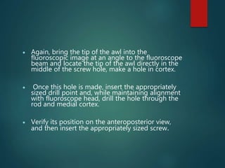  Again, bring the tip of the awl into the
fluoroscopic image at an angle to the fluoroscope
beam and locate the tip of the awl directly in the
middle of the screw hole, make a hole in cortex.
 Once this hole is made, insert the appropriately
sized drill point and, while maintaining alignment
with fluoroscope head, drill the hole through the
rod and medial cortex.
 Verify its position on the anteroposterior view,
and then insert the appropriately sized screw.
 