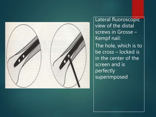 Lateral fluoroscopic
view of the distal
screws in Grosse –
Kempf nail:
The hole, which is to
be cross – locked is
in the center of the
screen and is
perfectly
superimposed
 