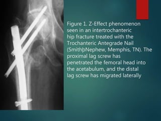 Figure 1. Z-Effect phenomenon
seen in an intertrochanteric
hip fracture treated with the
Trochanteric Antegrade Nail
(SmithþNephew, Memphis, TN). The
proximal lag screw has
penetrated the femoral head into
the acetabulum, and the distal
lag screw has migrated laterally
 