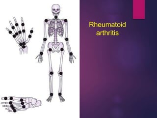 Rheumatoid
arthritis
 
