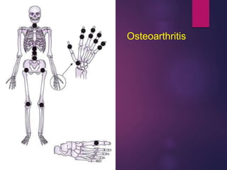 Osteoarthritis
 
