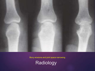 Radiology
Bony erosions and joint space narrowing
 