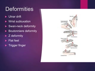 Deformities
 Ulnar drift
 Wrist subluxation
 Swan-neck deformity
 Boutonniere deformity
 Z deformity
 Flat feet
 Trigger finger
 