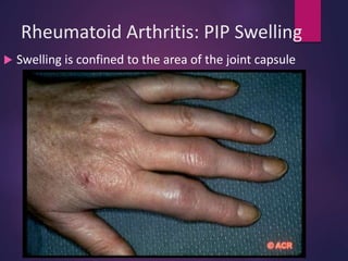 Rheumatoid Arthritis: PIP Swelling
 Swelling is confined to the area of the joint capsule
 