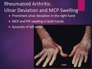 Rheumatoid Arthritis:
Ulnar Deviation and MCP Swelling
 Prominent ulnar deviation in the right hand
 MCP and PIP swelling in both hands
 Synovitis of left wrist
 
