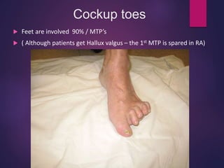 Cockup toes
 Feet are involved 90% / MTP’s
 ( Although patients get Hallux valgus – the 1st MTP is spared in RA)
 