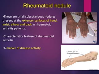 Rheumatoid nodule
•These are small subcutaneous nodules
present at the extensor surfaces of hand,
wrist, elbow and back in rheumatoid
arthritis patients.
•Characteristics feature of rheumatoid
arthritis
•A marker of disease activity
 