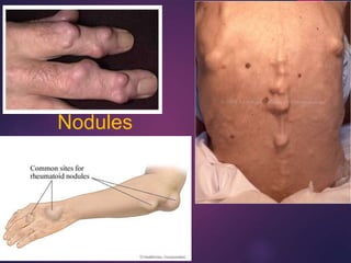 Nodules
 
